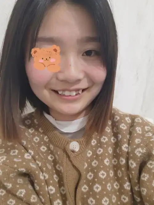 虎牙矫正  十几岁的时候,在牙科诊所看过,说要上拔两颗,下拔两颗.