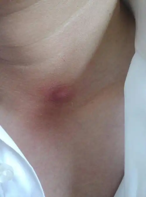 请大家告诉我脖子上的这个包是什么,谢谢!包不痛但有点痒.