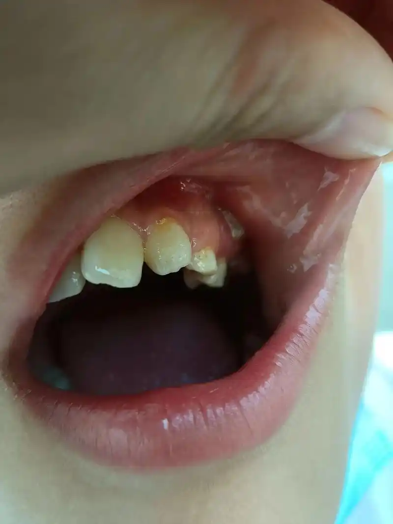 牙齿长到牙龈上,不容易呀!# - 抖音