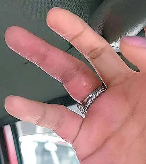 女星戒指戴太多险截肢 网友:图喜气炫财气也要注意安全啊