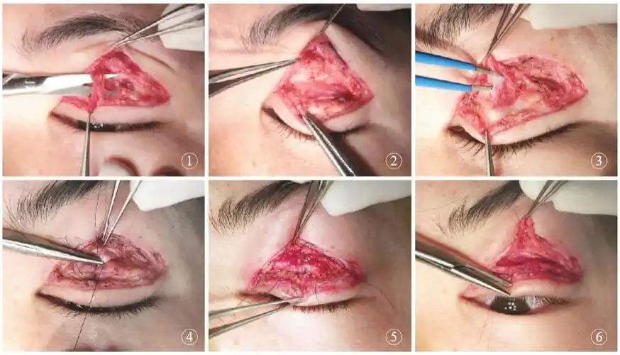 上睑翼状韧带悬吊修复额肌瓣矫正重度上睑下垂术后复发