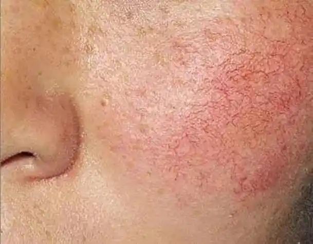 为何会有"红脸蛋",护肤品有用吗,有什么医美方法可以改善?