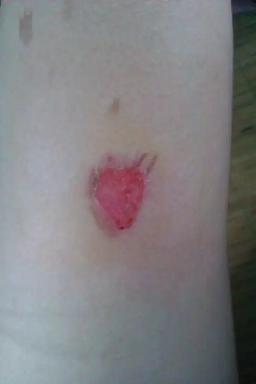 腿烫伤,起泡了泡破了.肉在外面.用不用去包扎?