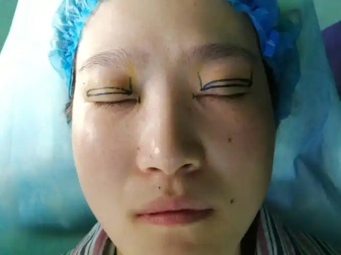 我的眼睛有点提肌无力,眼球暴露也不是很明显,看着有_圈子-新氧美容