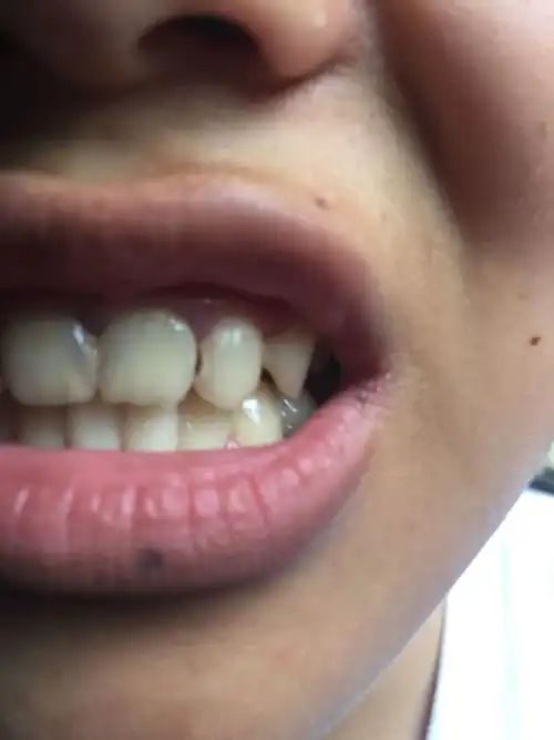 两颗门牙,两个侧切牙都烂了,都漏了神经,要杀神经吗,我才17岁,做烤瓷