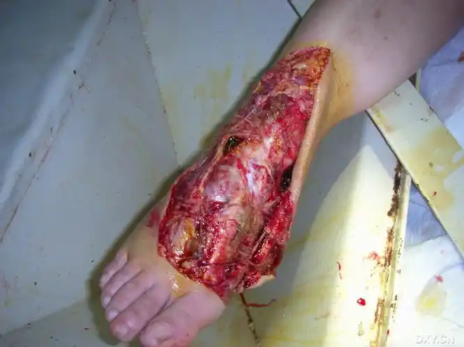 足部皮肤辗挫伤.大家来看看(附图片)