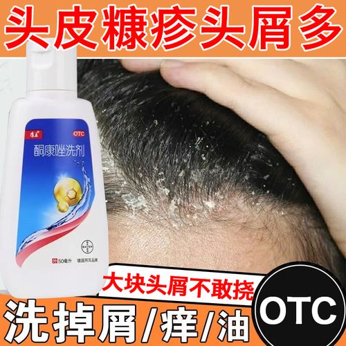 酮康唑洗剂 50ml 头皮瘙痒满头头皮屑专用药头皮糠疹脂溢性皮炎脱发