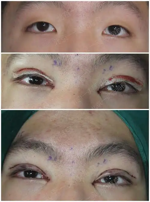 的上睑下垂矫正结果,术前必须仔细检查,正确选择最适合患者的手术方法