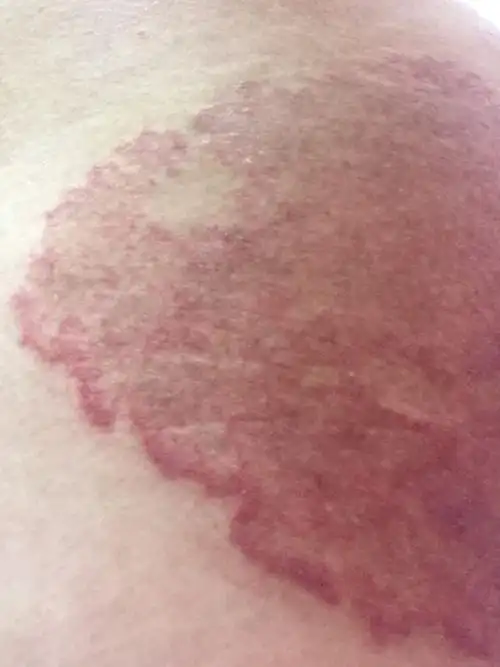 得了股癣,面积越来越大,颜色也变深了,有的时候痒有的时候疼.