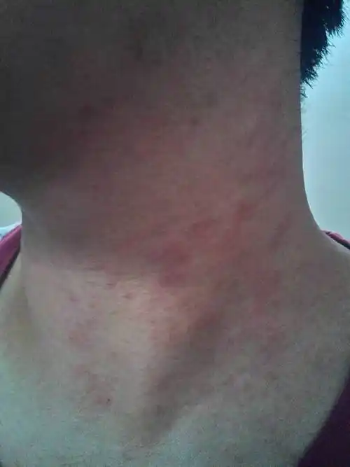 问:请问医生我的脖子是过敏了吗?有灼烧感,轻微瘙痒