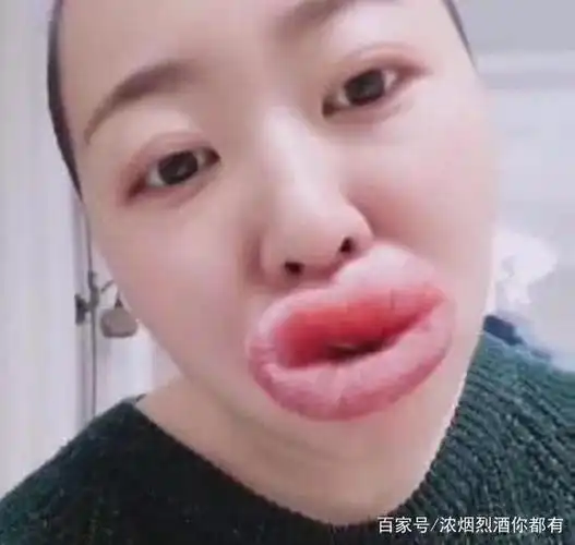 女子赴韩国整容失败,新款"嘟嘟唇"超抢镜,嘟嘟姐:甘拜下风!