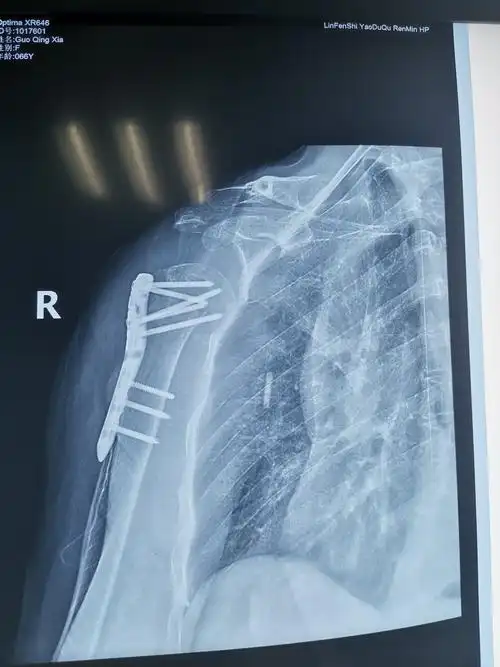 术后右肩关节斜位片