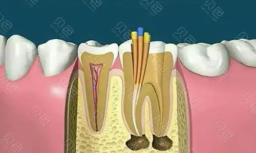 乌鲁木齐小白兔口腔根管治疗技术咋样?价格是多少?