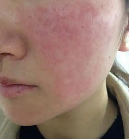 激素脸皮肤老的快是怎么回事?_症状