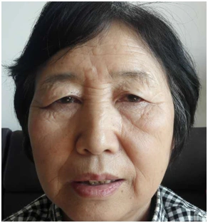 老年性眼睑皮肤松弛矫正手术前后对比照片 - 好大夫在线