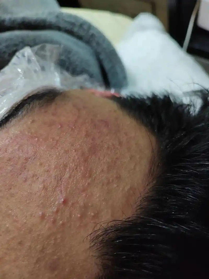 痘痘闭口粉刺一次解决还原平滑细腻的皮肤不再反弹