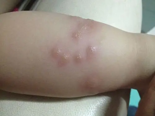 宝宝2岁多男孩身上起红疙瘩子很痒,都抓