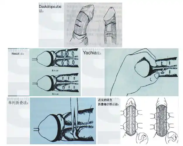 男性阴茎弯曲畸形及临床诊断治疗(精华帖)
