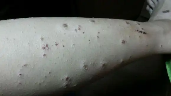 传销爱害者被人骗到江西传销回来就得了疥疮