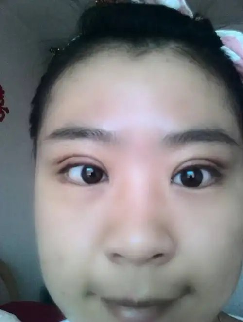 五年前做了埋线双眼皮,有一只眼睛开了,前两天做了修复双眼皮又全切开