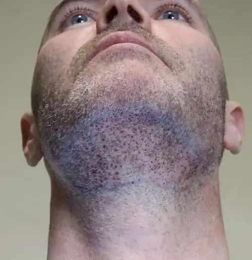 植发可以移植胡须吗?重度脱发也能救