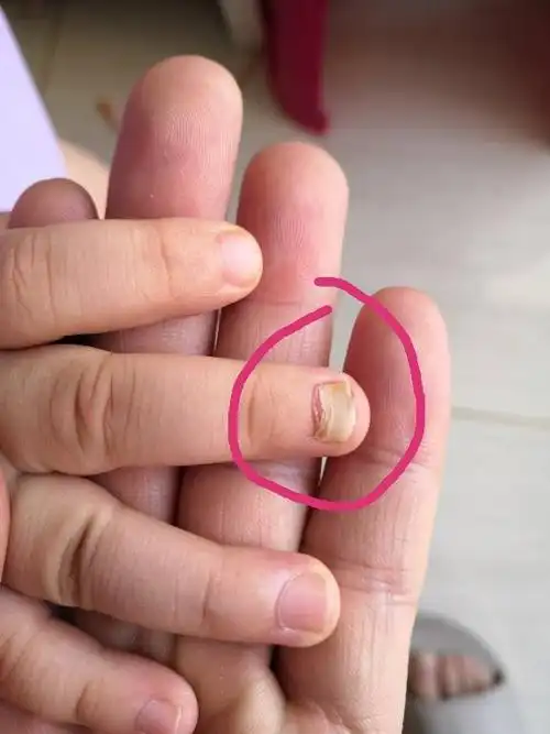 宝宝指甲之前被门夹到,现在从根部脱落了,会长出新指甲么?