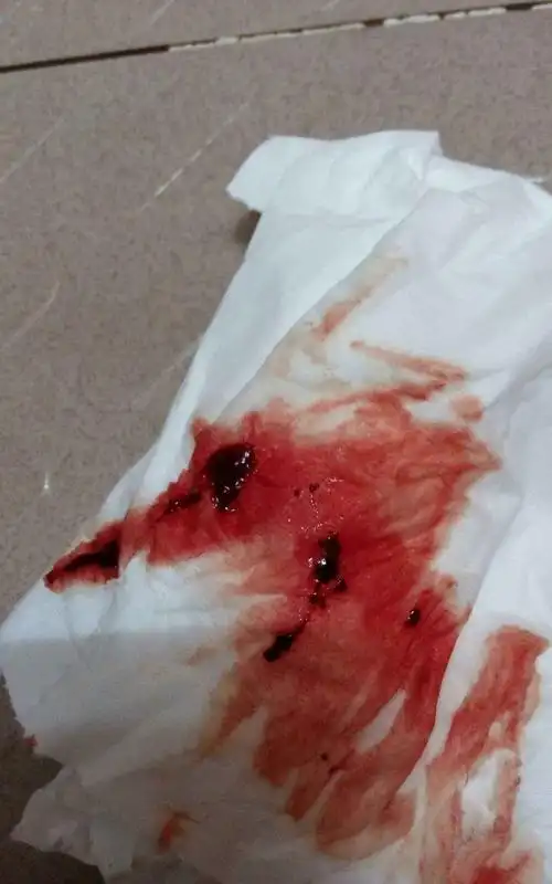 癌子宫息肉子宫内膜异位症盆腔炎症还有慢性子宫肥大症以及宫内节育器