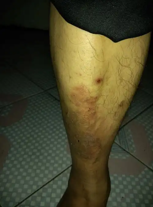 双小腿有皮疹,很红,很痒,抓破了就比较缓解,夏天有,冬天没有