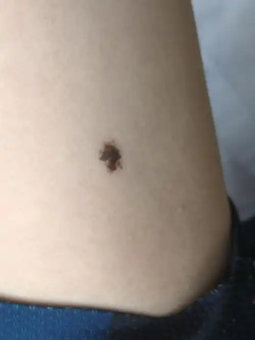 解决皮肤问题专注皮肤美容##色素痣