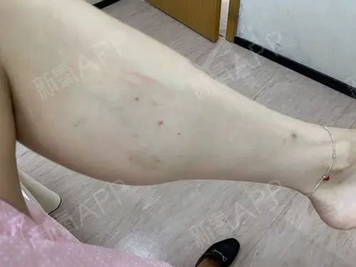 第一天 左,右小腿围33cm 人生第一次微整.紧张_圈子-新氧美容整形
