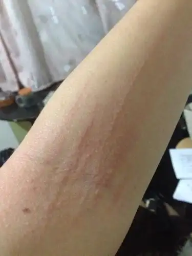 一到晚上皮肤就痒,越抓越痒,一抓就红,而且会肿起来,很像过敏了似的