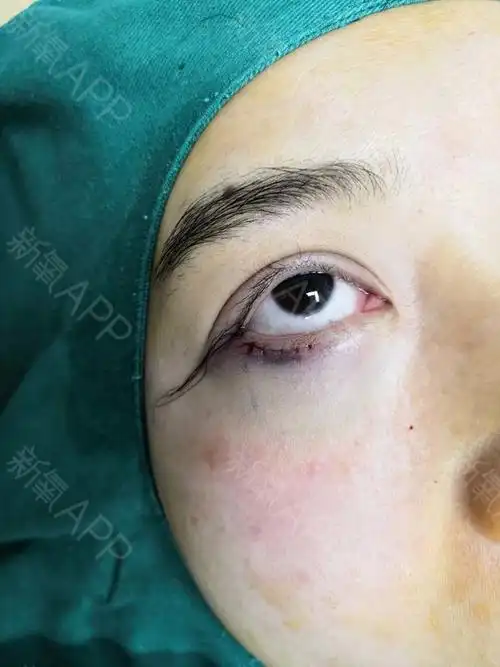 【南京柠檬医美外眼角 眼睑下至术后第0天】终于做完_圈子-新氧美容