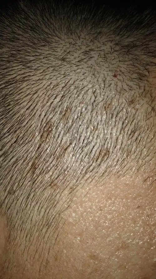 头皮两侧黑斑,这次一剃头发现的,是什么毛病,希望了解的