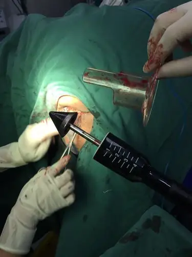 pph升级版—痔上黏膜c形切除钉合术在北京马应龙长青肛肠医院成功开展