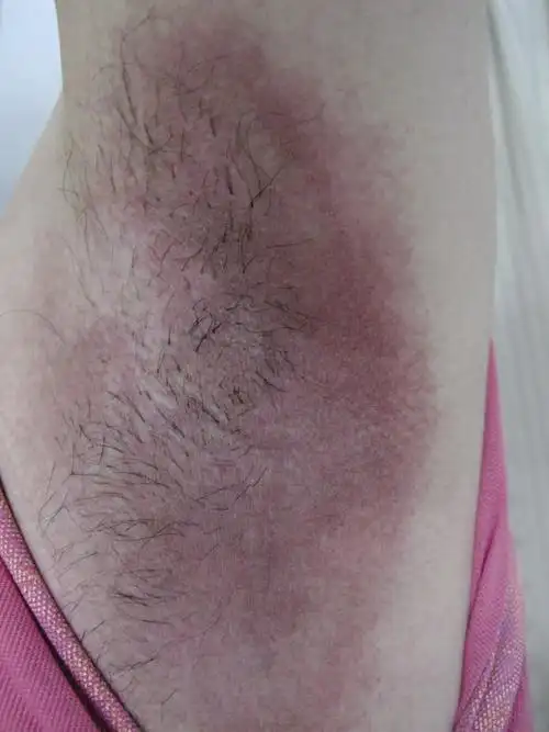 皮肤性病科图谱: 细菌性皮肤病 红癣