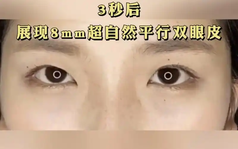 3秒后,看看8mm平行双眼皮是什么样?