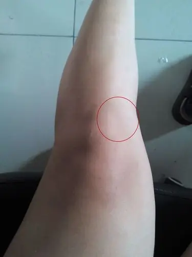 膝盖内侧弯曲处偏下方(具体位置见图片)很疼,尤其是一拍打就会痛,怎么