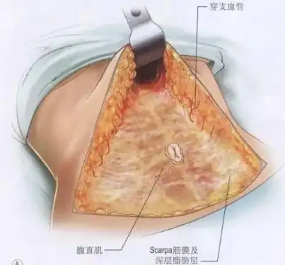 腹部拉皮术的手术原理和过程,以及优势下面也会大家奉上我做的功课吧!