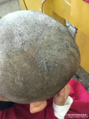 头皮问题的真相一(文章很长,没耐心的别看)