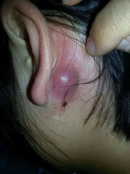 治疗后一个月复查,囊肿消