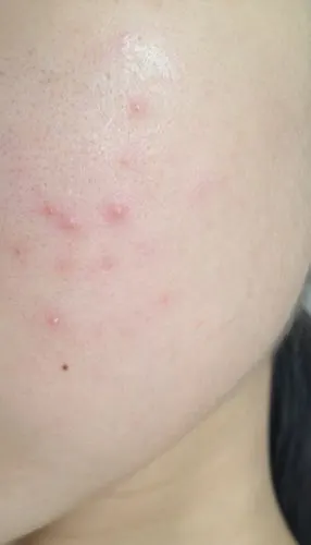 以前脸上从不长痘 最近长了很多 不知道是过敏还是什么 洗完脸 总是很