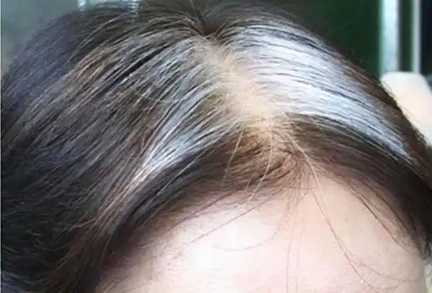 白发长在哪,病就在哪出?长在前额,两鬓,后脑勺,分别代表啥