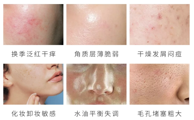 你的皮肤屏障有受损吗