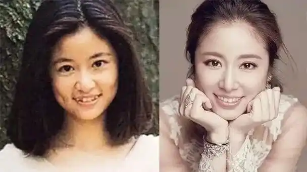 最具代表的就是早已完成牙齿矫正的angelababy,小s,高圆圆,林心如