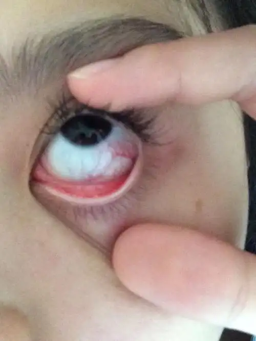 请我我的左眼干涩有轻微痛感 有严重红血丝!是什么情况!