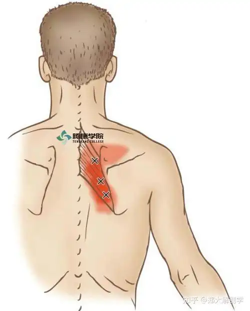 因此病变导致的疼痛为运动型,涉及菱形肌和肩胛提肌