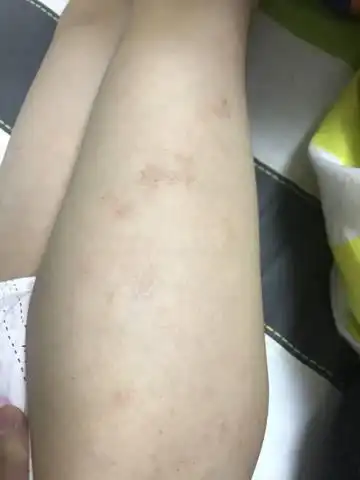 我女儿有严重的乾性湿疹 一热一干就起 夏天好一点 一到秋冬就严重