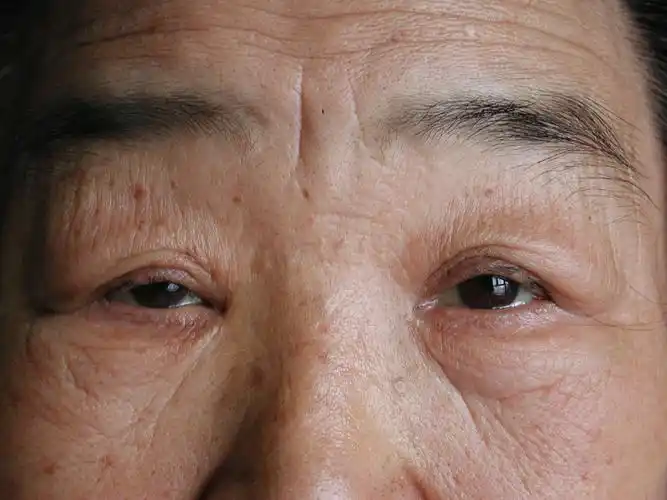 重症肌无力患者常见的三种危象 - 好大夫在线