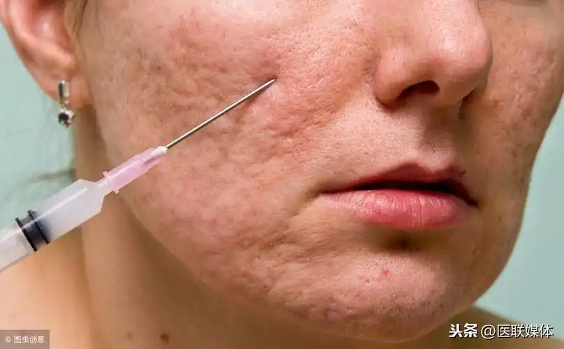 当人体皮肤老旧角质大批堆积后,皮肤就会变得粗糙,毛孔也会慢慢变大