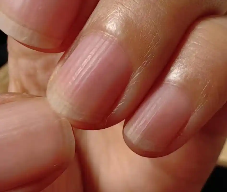 手指甲有竖纹,这是身体健康预警  一个健康的人,手指甲盖应该是红润